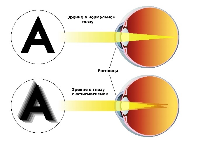 Астигматизм